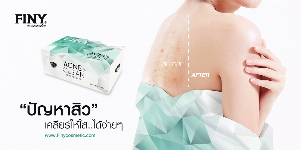 สบู่สิว,แก้ปัญหาสิวที่หลัง,สิวที่หลัง,ลดสิว,กำจัดสิว,เจลล้างหน้า,เจลล้างหน้าสิว,สิว,ล้างสิว,กำจัดสิว,ล้างสิวออก,ล้าวผิว,เจลล้างหน้าสิวหลุด,สิวผด,สิวเม็ดใหญ่,สิวหาย,ครีมหน้าใส,ฝ้าขาว,ครีมฟ้าขาว,หน้าใส,ครีมบำรุง,ลดฝ้า,เซรั่ม,ผิวหน้าขาว,ครีมทาฝ้า,ครีมลดฝ้า,ฝ้าหาย,ขาวครีม,ลดกระ,ซีรั่ม,ครีมฟ้าขาวหน้าใส,ผิวหน้าขาว,หน้าขาว,ครีมลดกระ,หน้าใส,กระ,ครีมหน้าขาว,หน้าใส,ครีมฟ้าขาวของแท้,รักษาสิว,สิวหาย,ลดสิว,สิวอุดตัน,สิว,หน้าตึง,ขาวหน้า,ครีมทาหน้า,ครีมบำรุงผิว,เซรั่มวิตามินซี,เซรั่มบำรุงหน้า,โฟมล้างหน้า,สบู่วิตามินซี,สบู่นำเข้า,facial soap,Acne Clear,ครีมกันแดด,ผิวกระจ่างใส,ครีมกันแดดทาหน้า,ฟินนี่,คอสเมติกส์